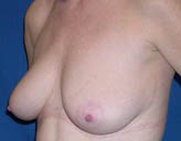 Patient # 13343 Before Photo # 5