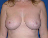 Patient # 88738 After Photo # 2