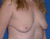 Patient # 88738 Before Photo # 3