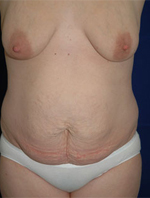 Patient # 47109 Before Photo # 1