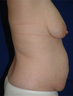 Patient # 47109 Before Photo # 3