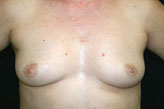 Patient # 24157 Before Photo # 1