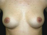 Patient # 35597 Before Photo # 1