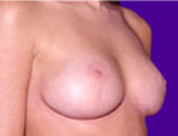 Patient # 18071 After Photo # 2