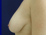 Patient # 24164 Before Photo # 1
