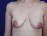 Patient # 79813 Before Photo # 1