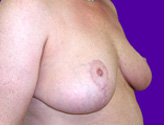 Patient # 47836 After Photo # 2