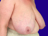 Patient # 47836 Before Photo # 1