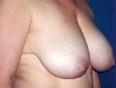Patient # 85232 Before Photo # 1