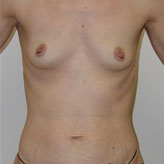 Patient # 73035 Before Photo # 1