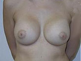 Patient # 51368 After Photo # 2