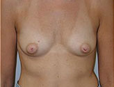 Patient # 51368 Before Photo # 1
