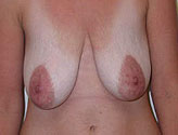 Patient # 40633 Before Photo # 1