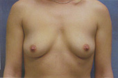 Patient # 61190 Before Photo # 1