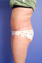 Patient # 70677 After Photo # 4