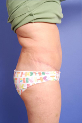 Patient # 70677 After Photo # 6