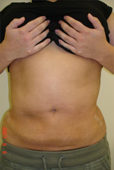 Patient # 57914 After Photo # 2