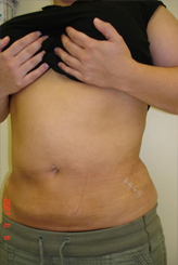Patient # 57914 After Photo # 4