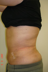 Patient # 57914 After Photo # 6
