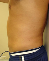 Patient # 72504 After Photo # 2