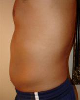 Patient # 72504 Before Photo # 1