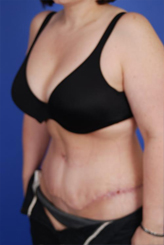 Patient # 20476 After Photo # 4