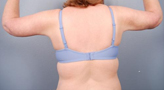 Patient # 18789 After Photo # 4
