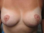 Patient # 39690 After Photo # 2