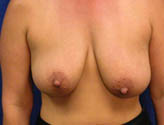 Patient # 37708 Before Photo # 1