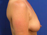 Patient # 37708 Before Photo # 3