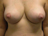 Patient # 17179 After Photo # 2