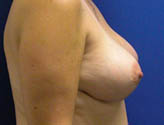 Patient # 17179 After Photo # 4