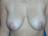 Patient # 17179 Before Photo # 1