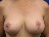 Patient # 63331 After Photo # 2
