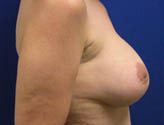 Patient # 63331 After Photo # 4