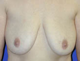 Patient # 63331 Before Photo # 1