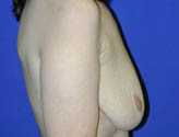 Patient # 63331 Before Photo # 3