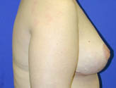 Patient # 74636 After Photo # 4