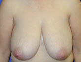 Patient # 74636 Before Photo # 1