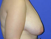 Patient # 74636 Before Photo # 3