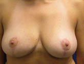 Patient # 41033 After Photo # 2