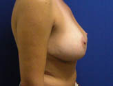 Patient # 41033 After Photo # 4