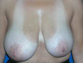 Patient # 41033 Before Photo # 1