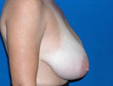 Patient # 41033 Before Photo # 3