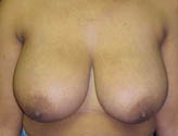 Patient # 34719 Before Photo # 1
