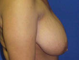 Patient # 34719 Before Photo # 3