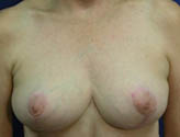 Patient # 61348 After Photo # 2