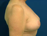 Patient # 61348 After Photo # 4