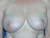 Patient # 61348 Before Photo # 1