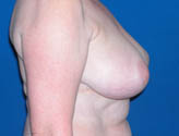 Patient # 61348 Before Photo # 3